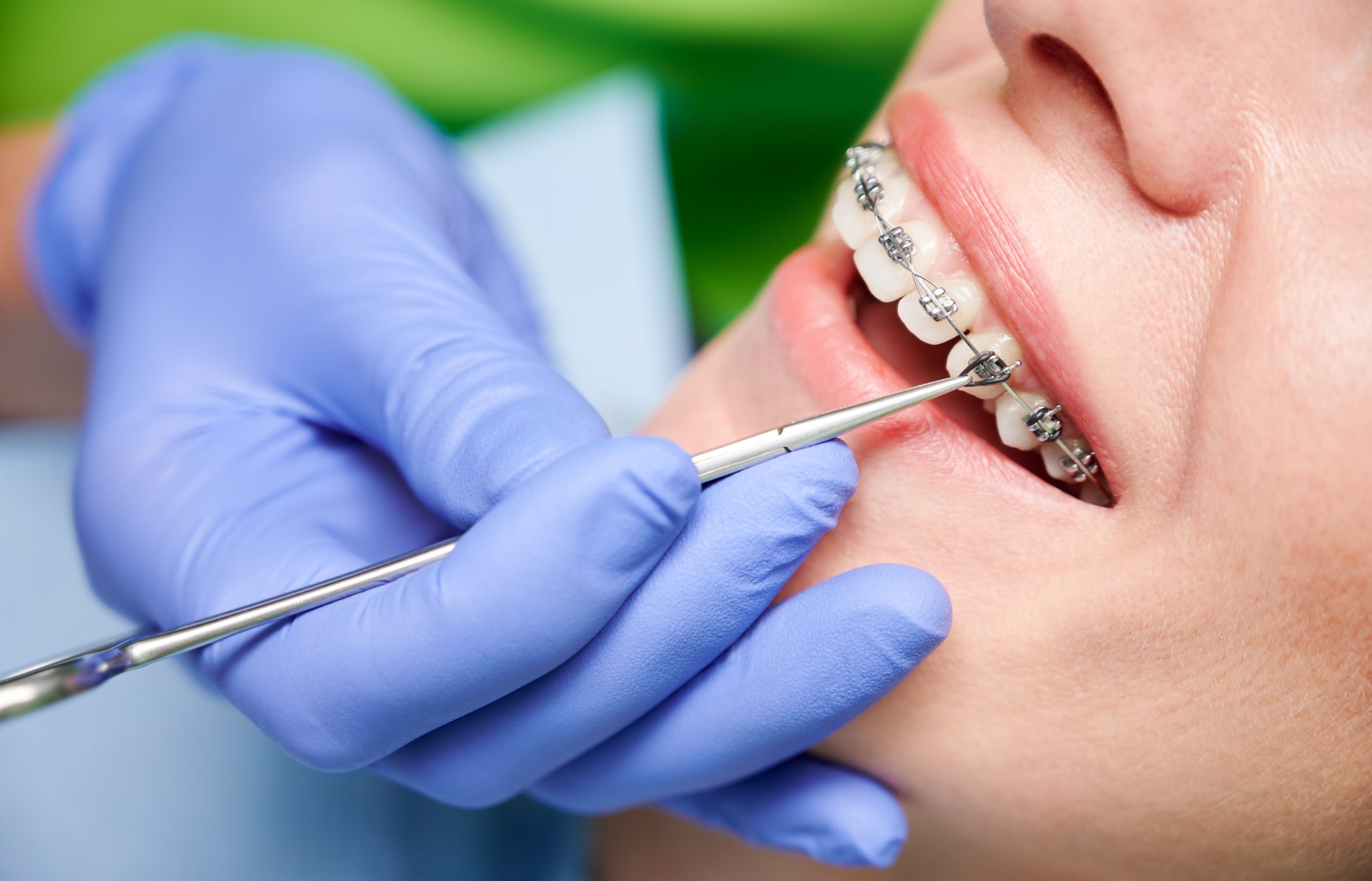 Choisir la Bonne Fixation pour Votre Prothèse Dentaire Amovible 