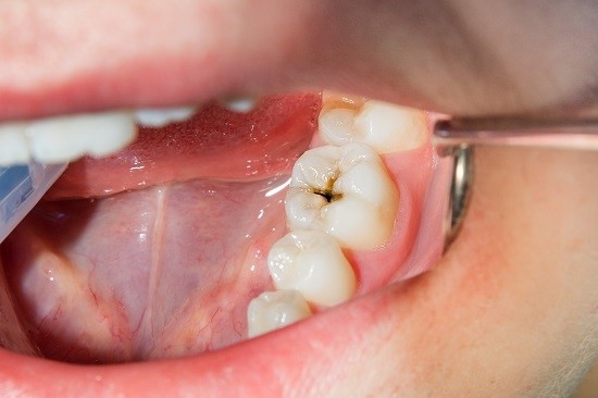 Comment minimiser la douleur lors d'une dévitalisation dentaire 