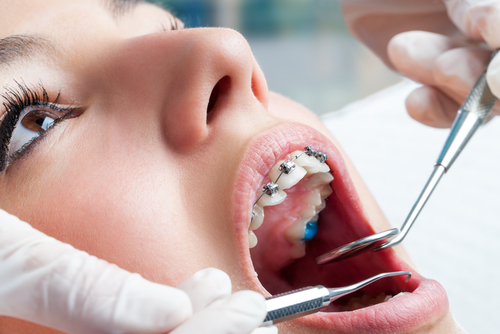 Dentosmile vs Invisalign Comparaison des Caractéristiques 
