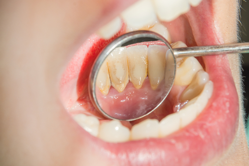 L’Effet des Comprimés Révélateur de Plaque Dentaire Sur Votre Hygiène Buccale 