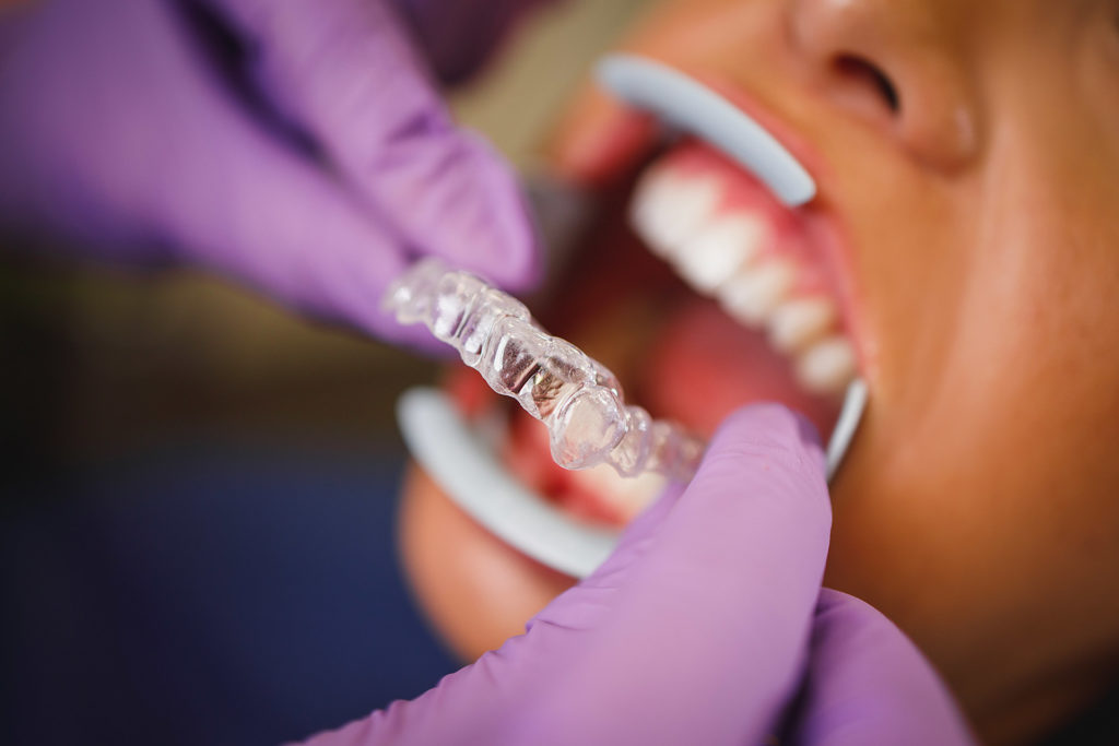 Le Choix des Patients Retours d'Expérience sur Dentosmile et Invisalign 