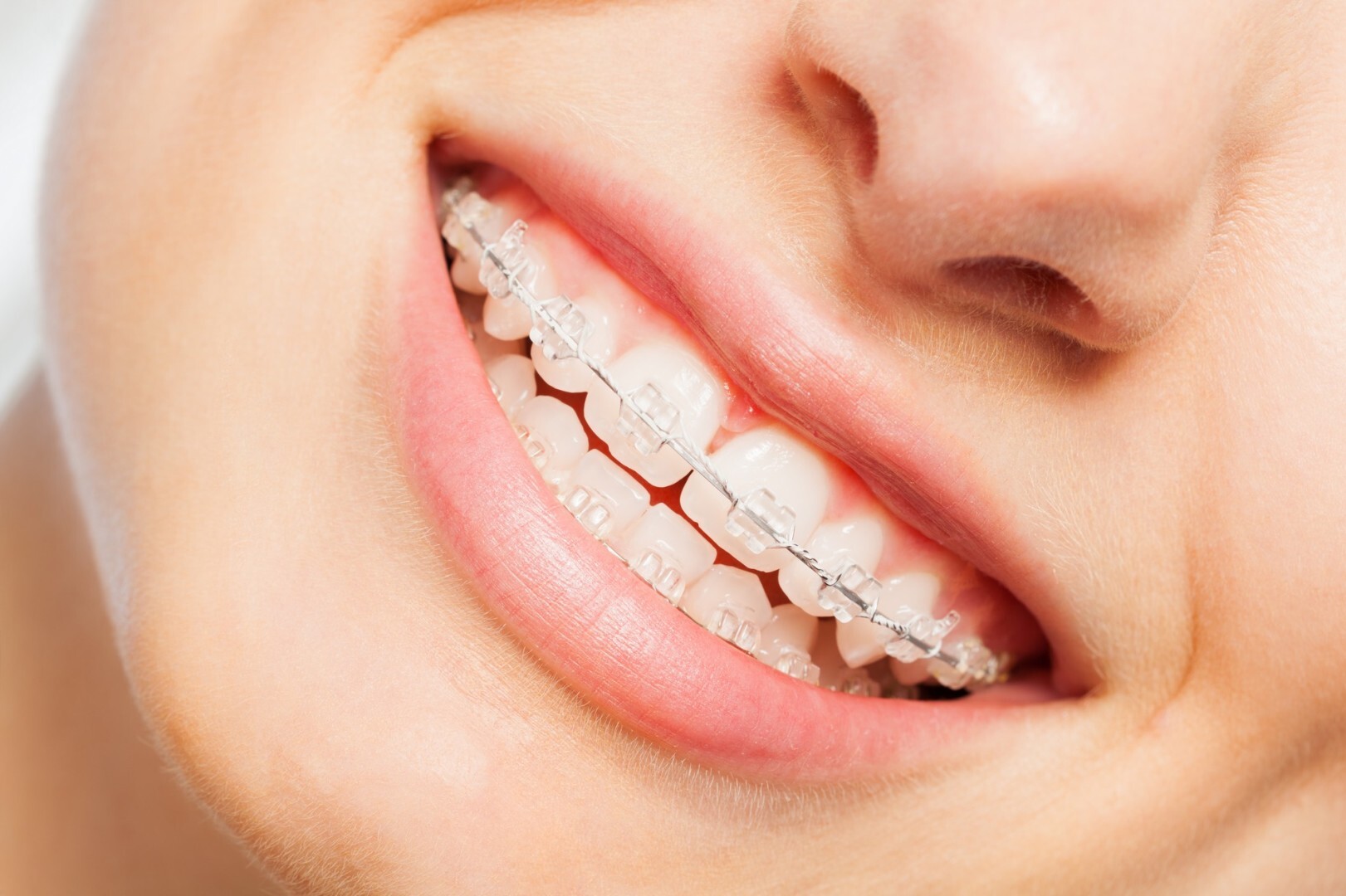 Les aligneurs Dentosmile Une introduction à la révolution orthodontique 