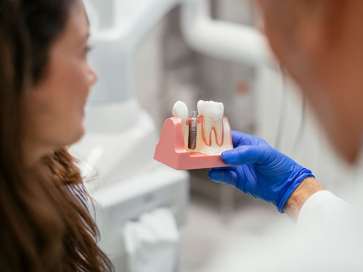 Les tarifs des implants dentaires dans le Nord Lille et Grenoble 