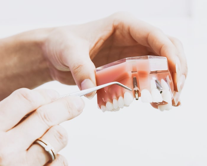 Quel est le prix moyen d'un implant dentaire tout compris en France