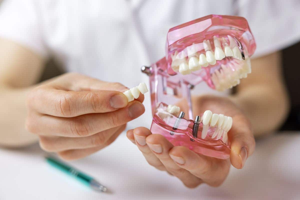 Témoignages Réels Forum Bridge ou Implant Dentaire 