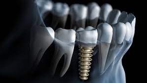 Découvrez la différence que les implants dentaires peuvent apporter à la qualité de votre vie