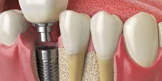 Les implants dentaires ont généralement une durée