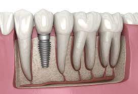 Les implants dentaires ressemblent à vos dents naturelles
