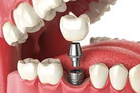 Quels sont les bénéfices et les avantages des implants dentaires